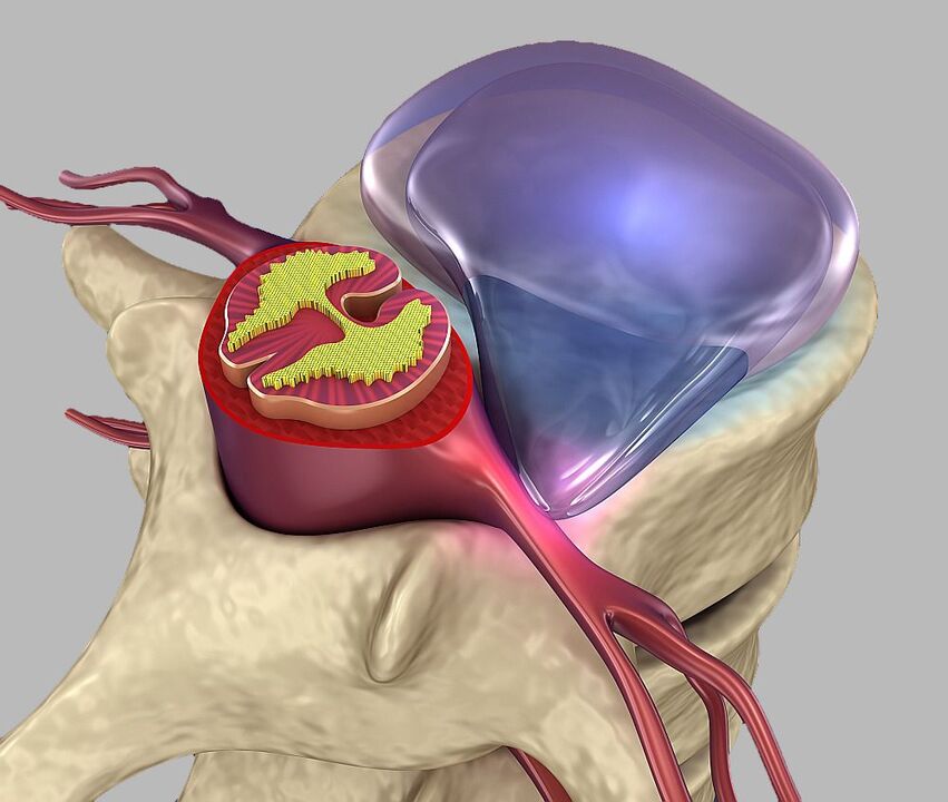 impotence due to pinched spinal roots