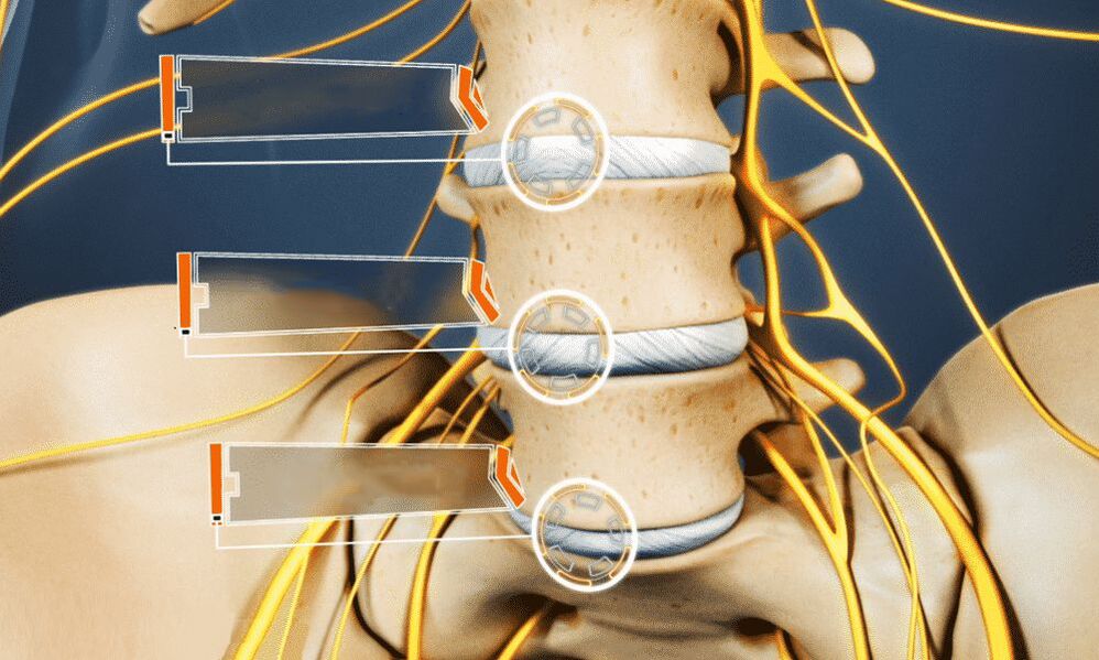 intervertebral hernia leads to impotence