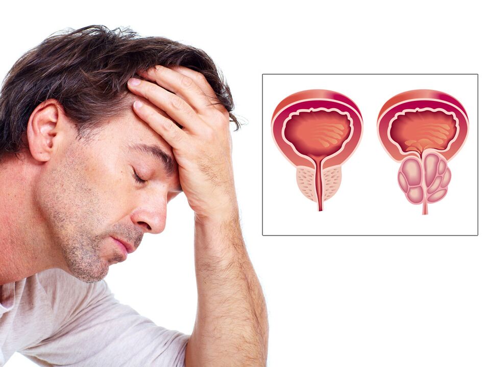prostate adenoma with impotence